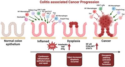 Overcoming cancer risk in inflammatory bowel disease: new insights into preventive strategies and pathogenesis mechanisms including interactions of immune cells, cancer signaling pathways, and gut microbiota